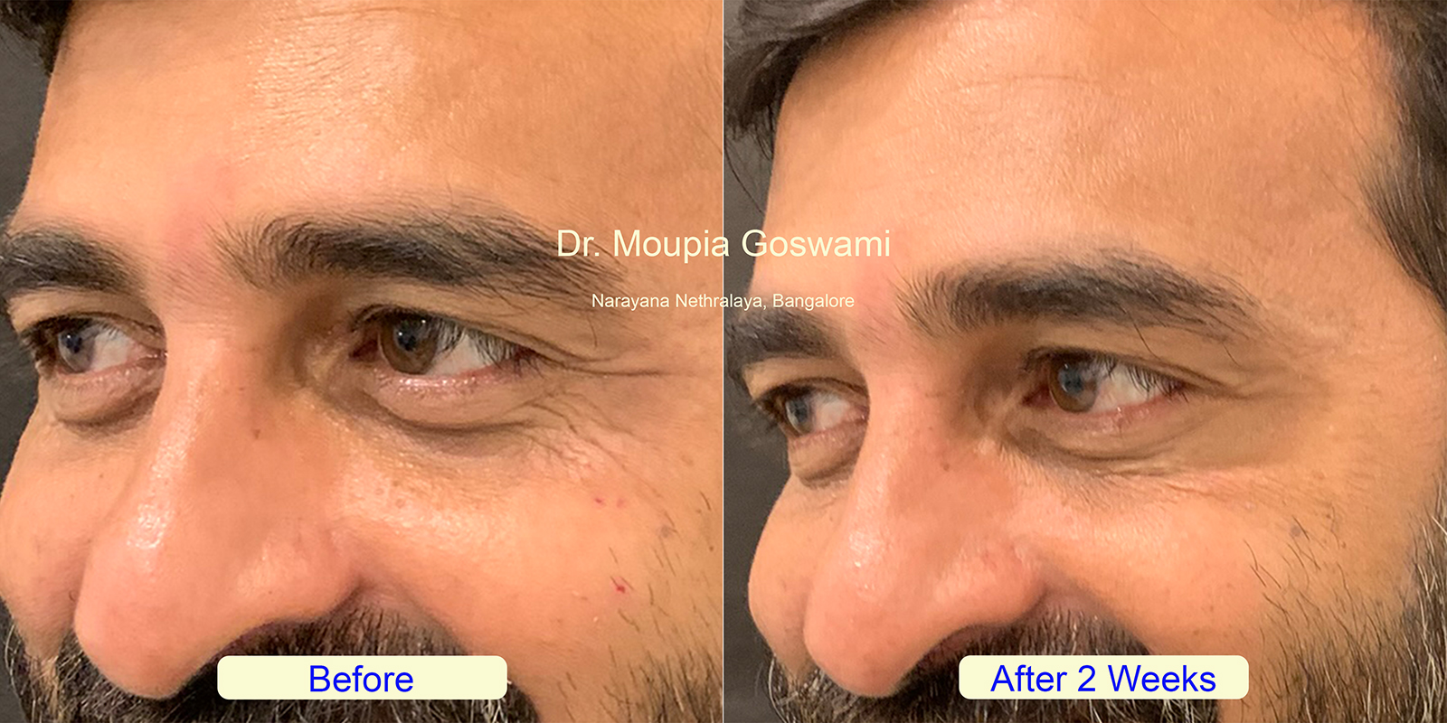Crows Feet Treatment Before and After - Case 2