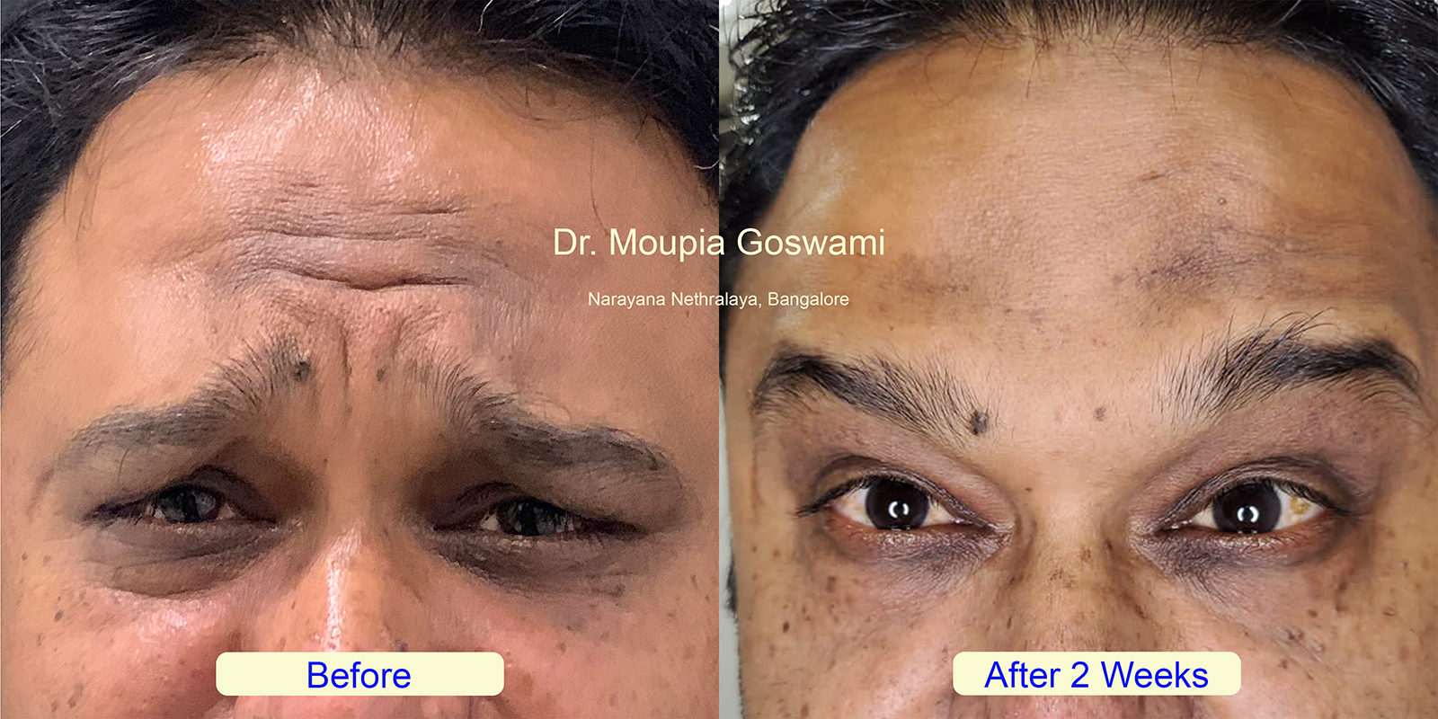 Forehead Wrinkles Treatment Before and After - Case 2