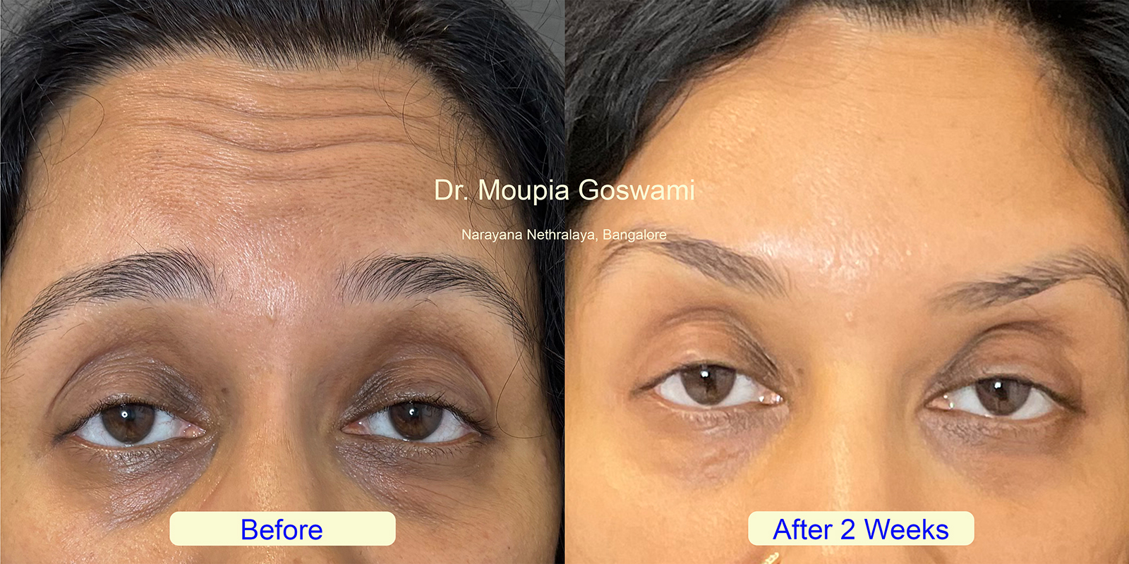 Forehead Wrinkles Treatment Before and After - Case 3