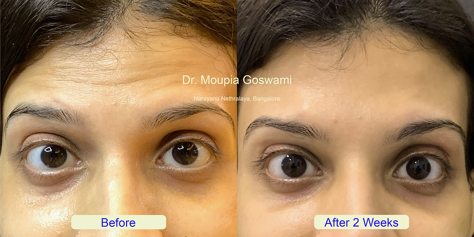 Forehead Wrinkles Treatment Before and After - Case 5