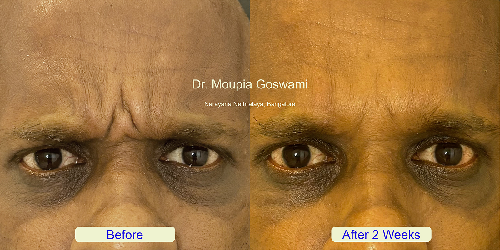 Gummy Smile Treatment Before and After - Case 1