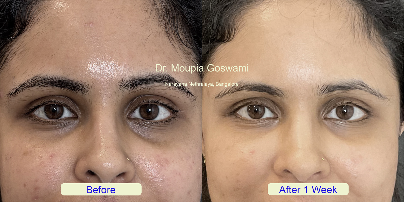 Forehead Wrinkles Treatment Before and After - Case 4