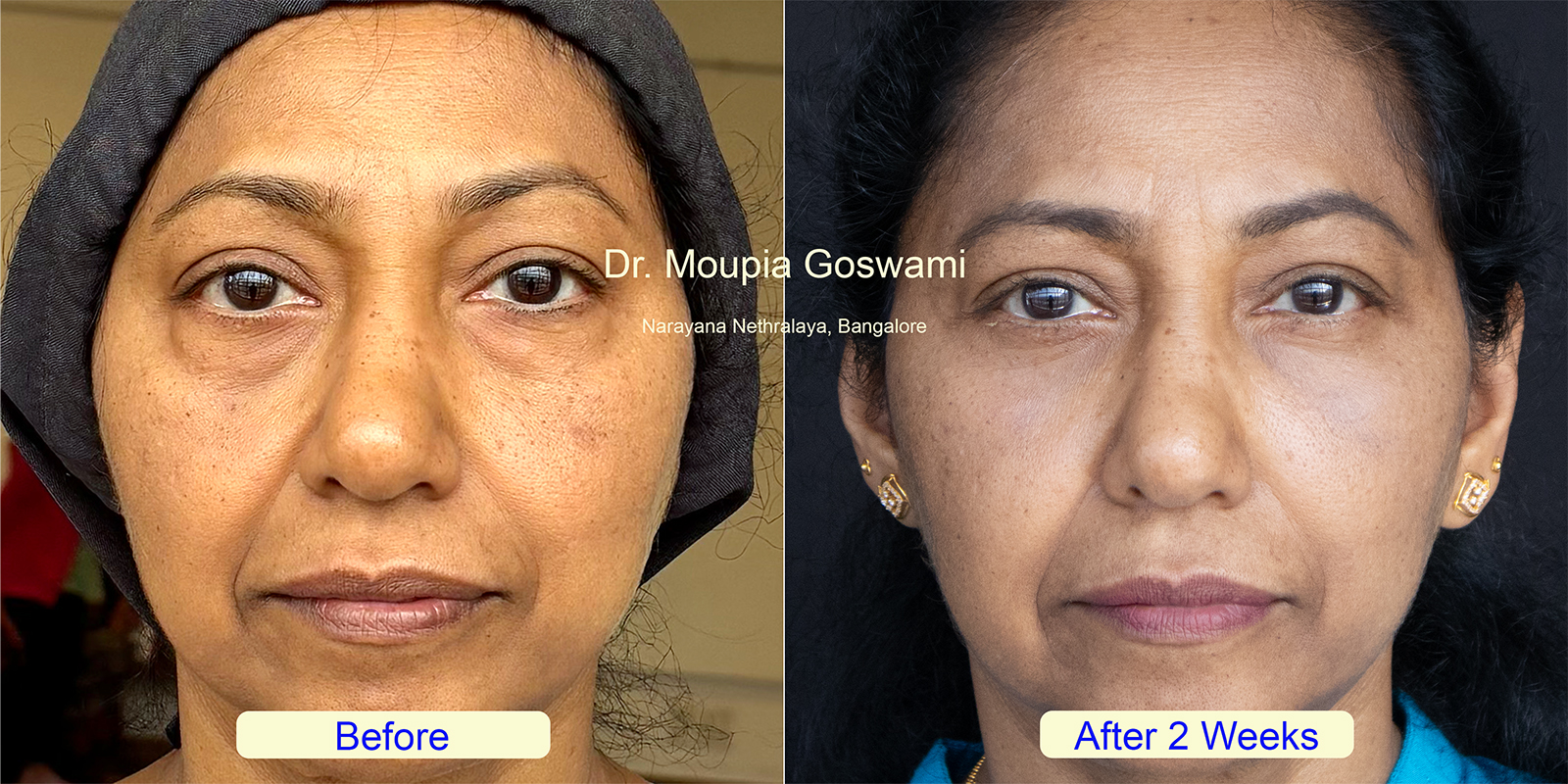Lower Blepharoplasty Before and After - Case 1