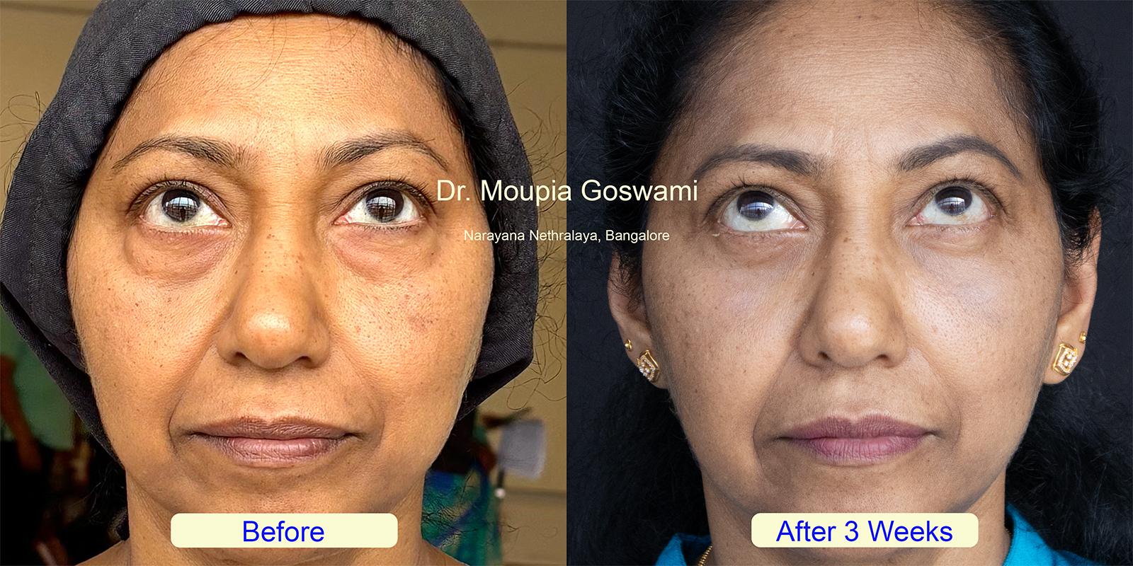 Lower Blepharoplasty Before and After - Case 2