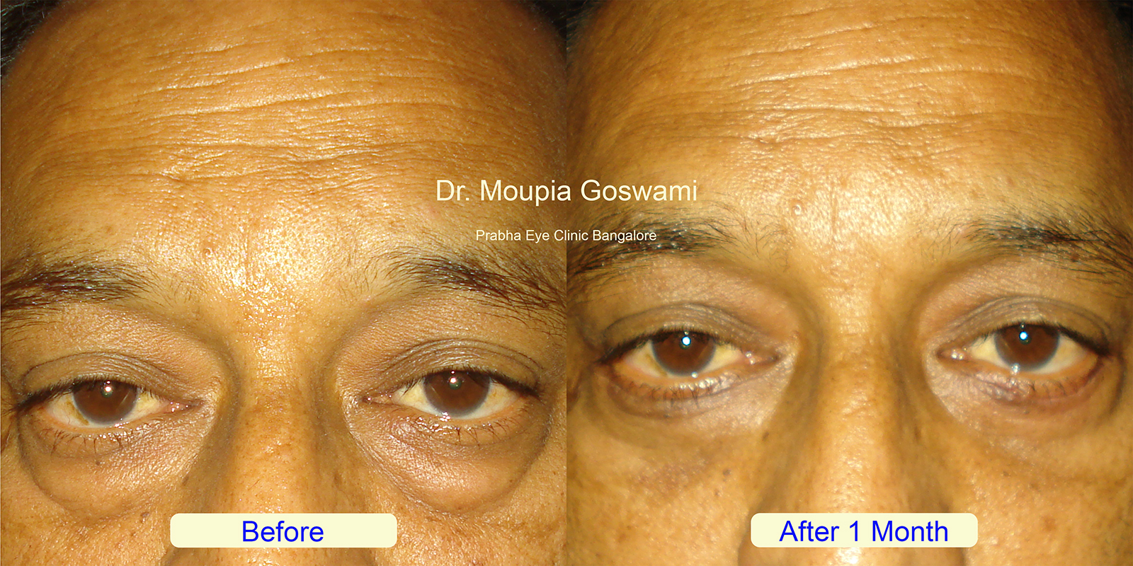 Lower Blepharoplasty Before and After - Case 3