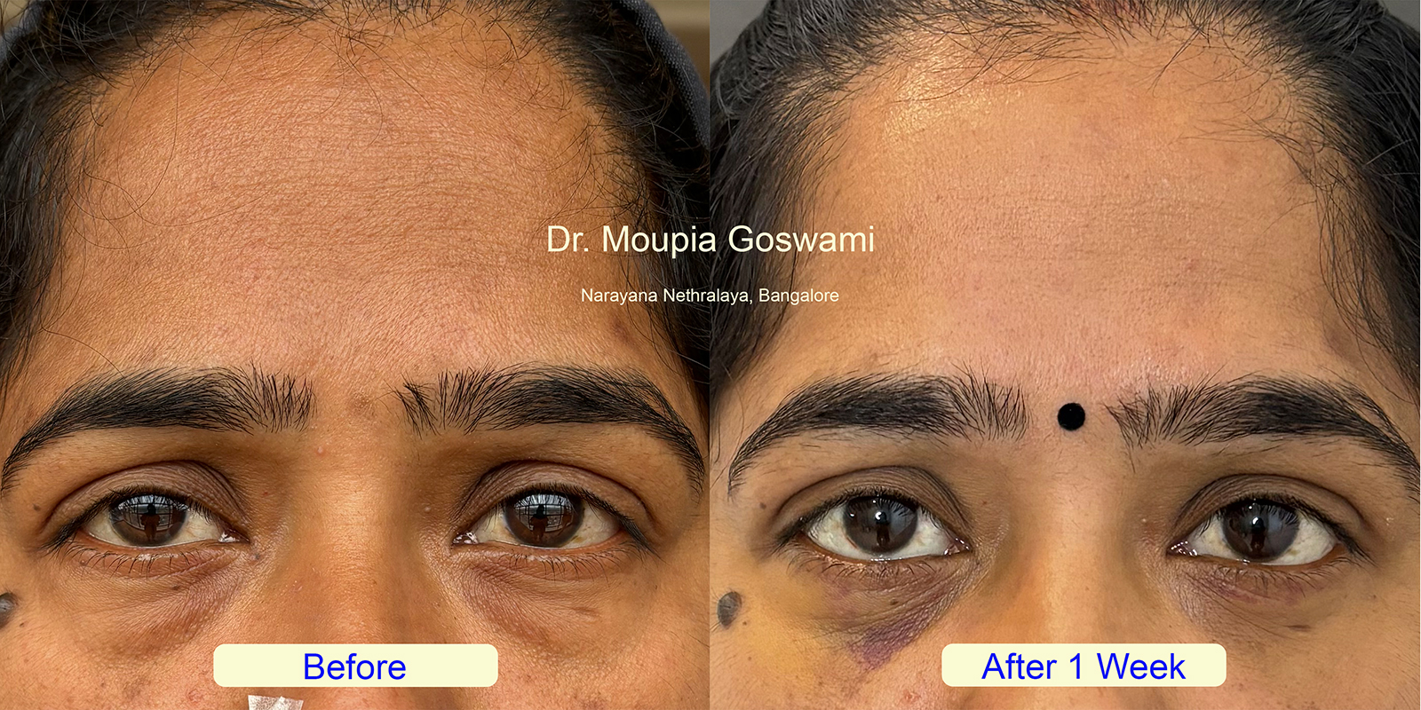 Lower Blepharoplasty Before and After - Case 5