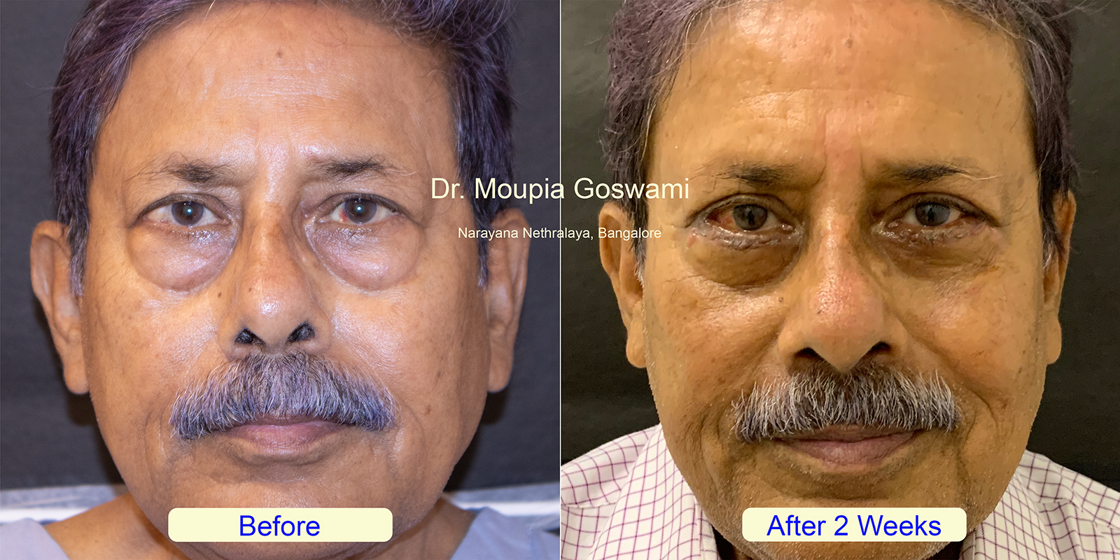 Quad Blepharoplasty Before and After - Case 2