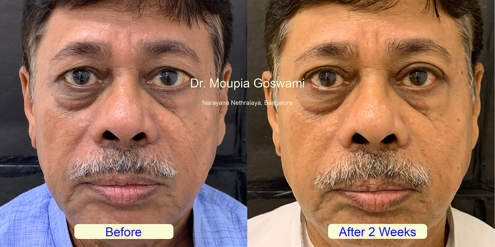 Upper Blepharoplasty Before and After - Case 2