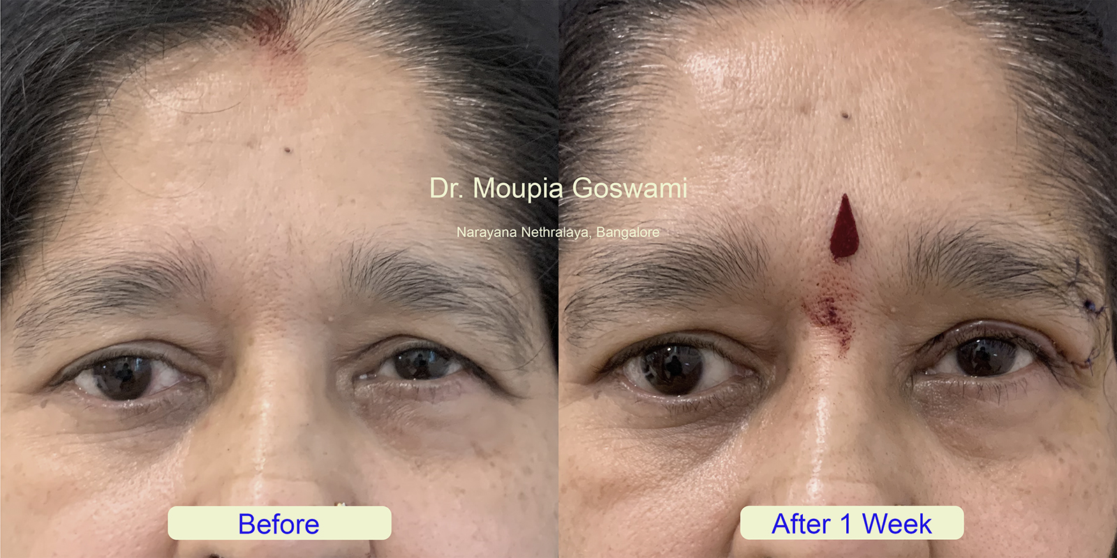 Brow Lift Before and After - Case 2a