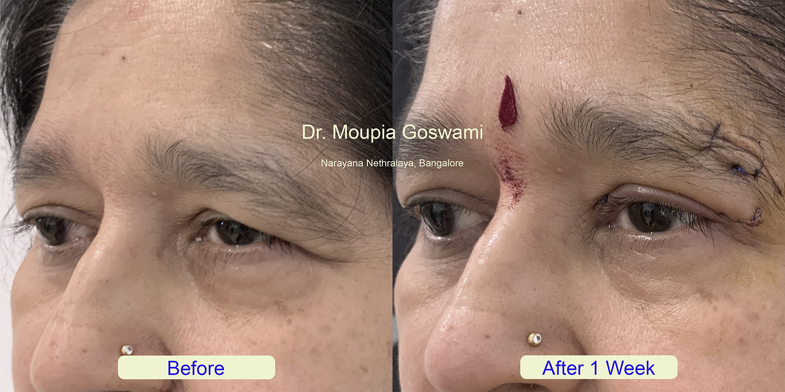 Brow Lift Before and After - Case 2b