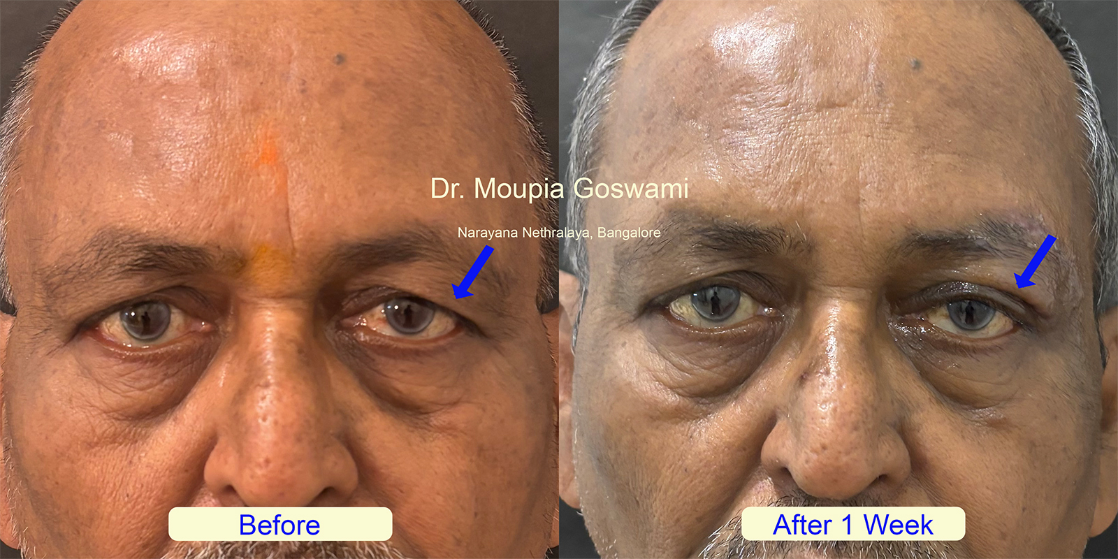 Brow Lift Before and After - Case 2b