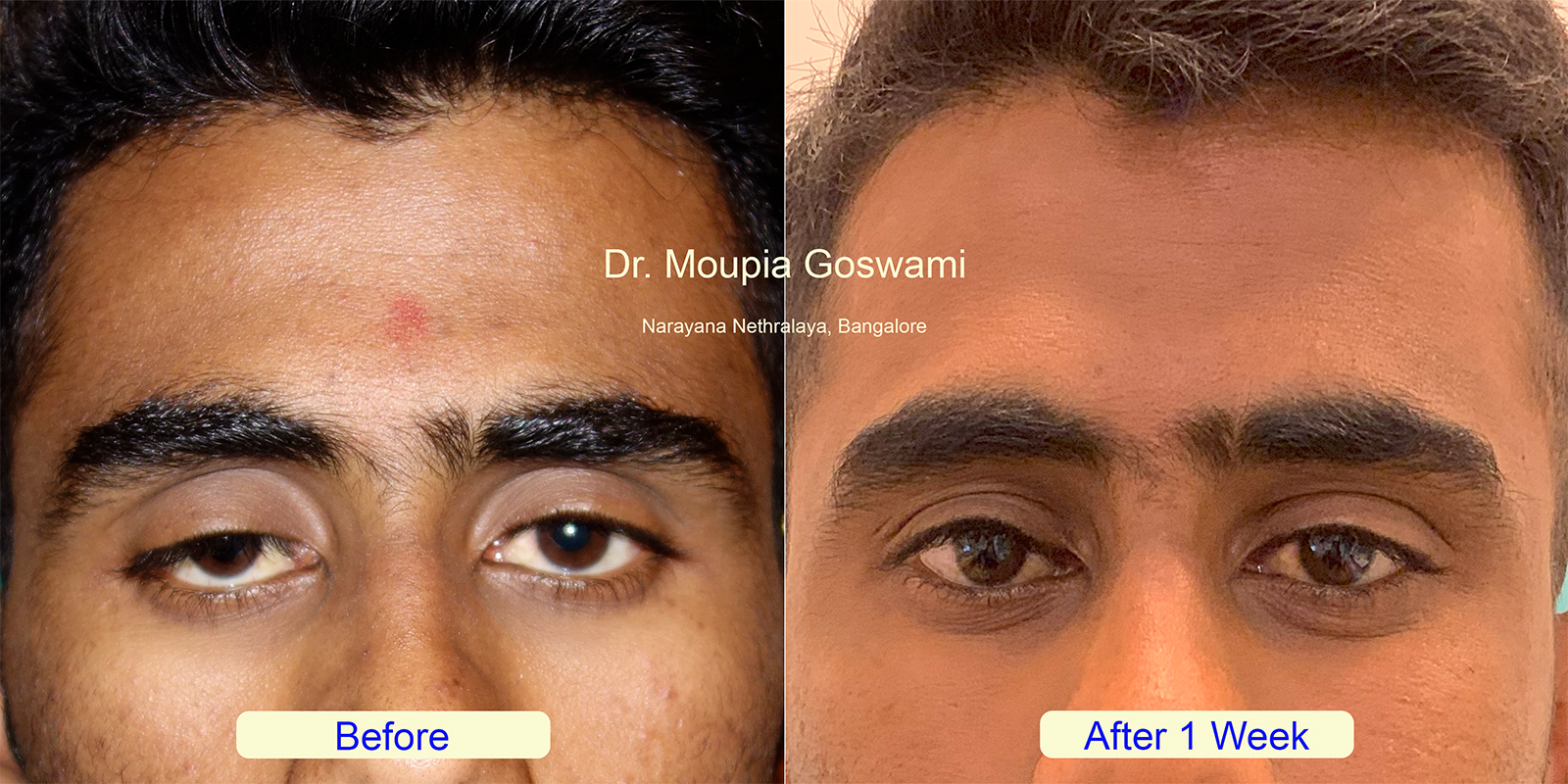 Ptosis before after - Case 11