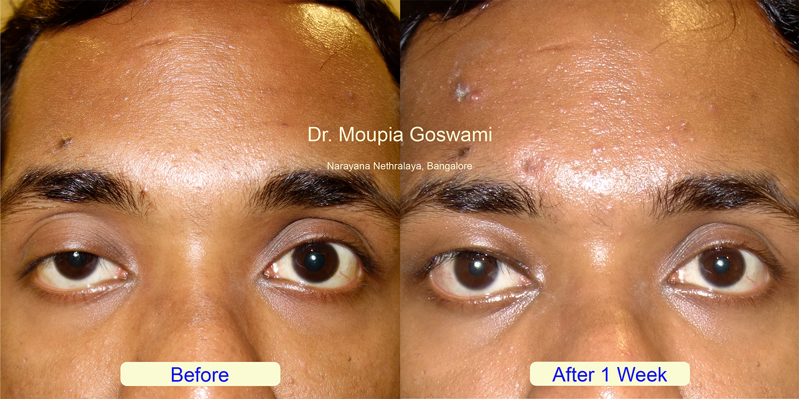 Ptosis before after - Case 3