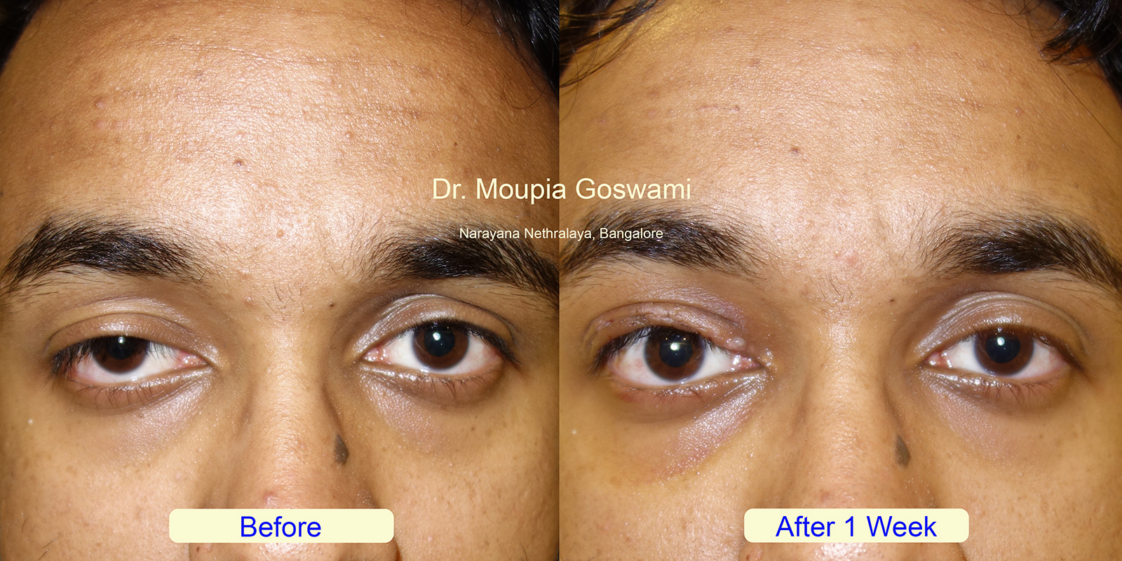 Ptosis before after - Case 5
