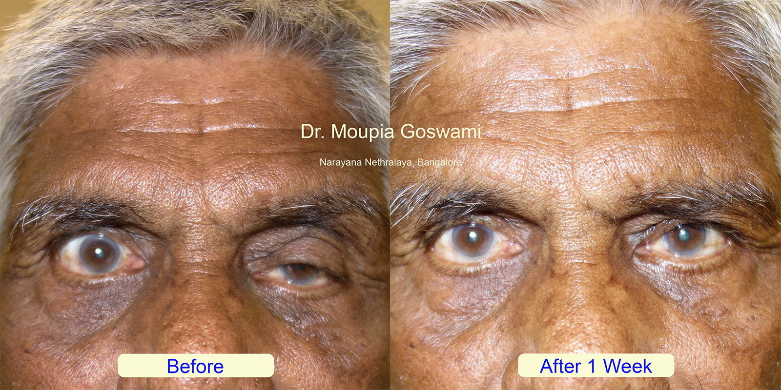 Ptosis before after - Case 7