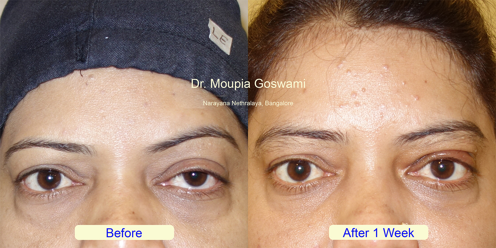 Ptosis before after - Case 8