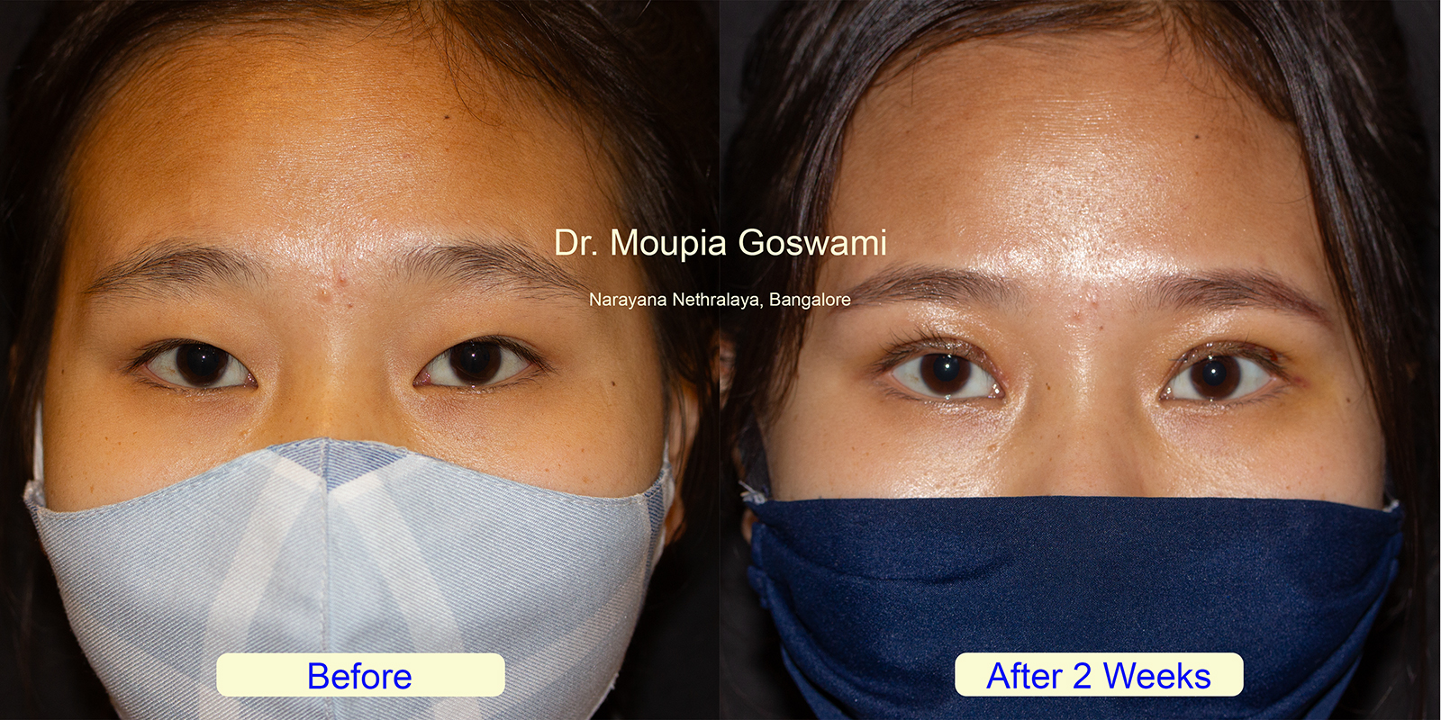 Before and After Eyelid Enhancement