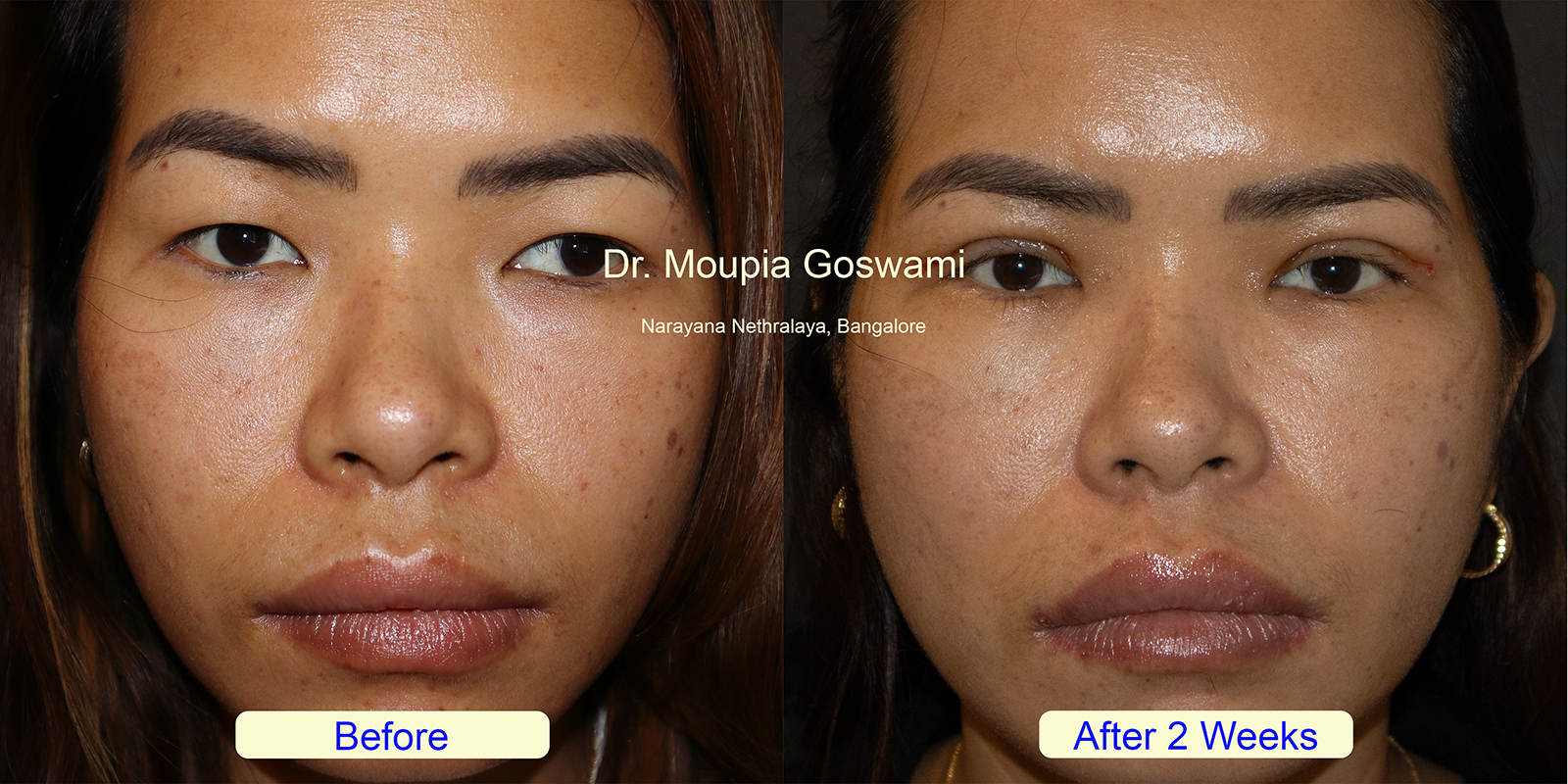 Eyelid Enhancement Results