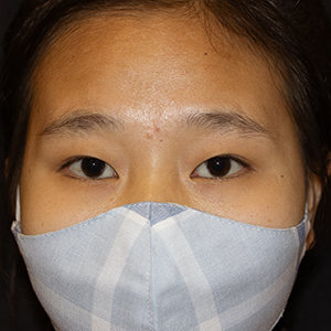 Photo 1 of a lady with Asian Eyelid or Monolid