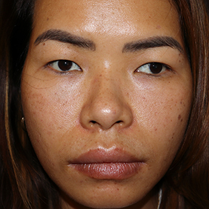 Photo 2 of a lady with Asian Eyelid or Monolid