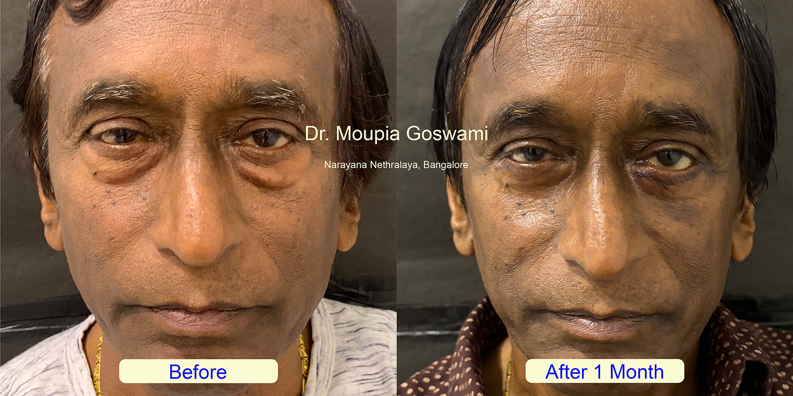 Successful baggy eyes blepheroplasty treatment results in Bangalore - Before and After by Dr. Moupia Goswami