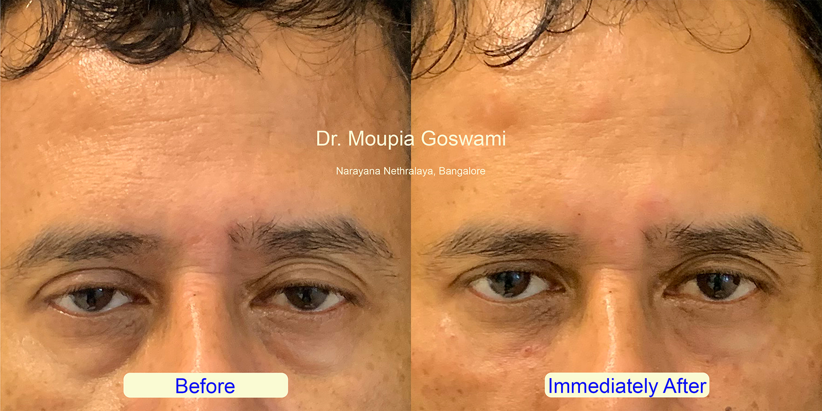 Successful baggy eyes filler treatment results in Bangalore - Before and After by Dr. Moupia Goswami