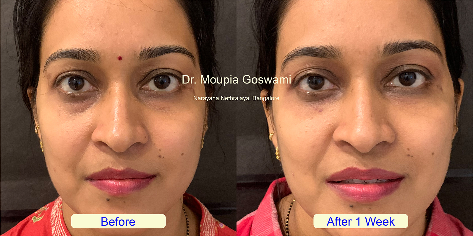 Successful baggy eyes filler treatment results in Bangalore - Before and After by Dr. Moupia Goswami