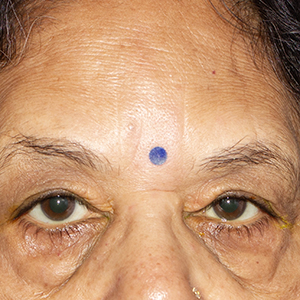 Severe baggy eyes surgery in Bangalore - Expert surgical treatment
