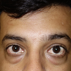Moderate under eye bags treatment in Bangalore - Advanced medical care