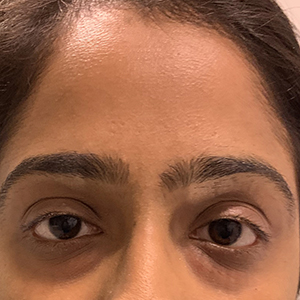 Early stage baggy eyes treatment in Bangalore - Non-surgical solutions available