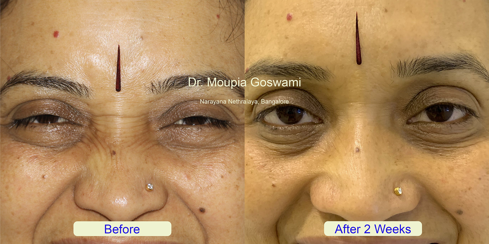 Eyelid Enhancement Results