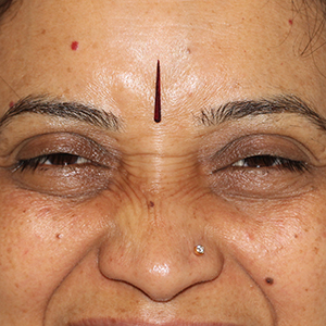 Photo 1 of a lady with Asian Eyelid or Monolid