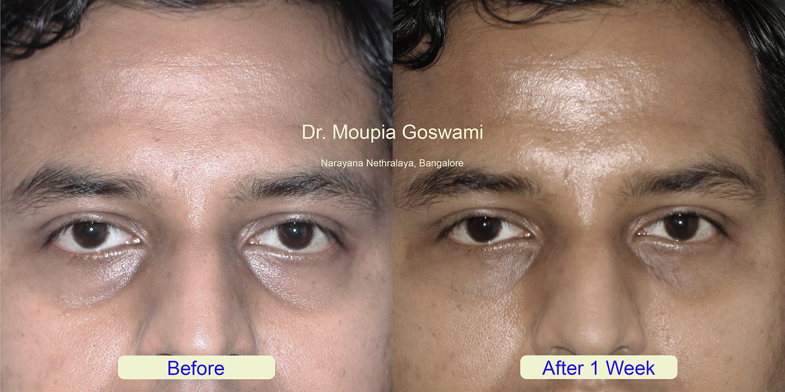 Dark circle treatment before after image 1