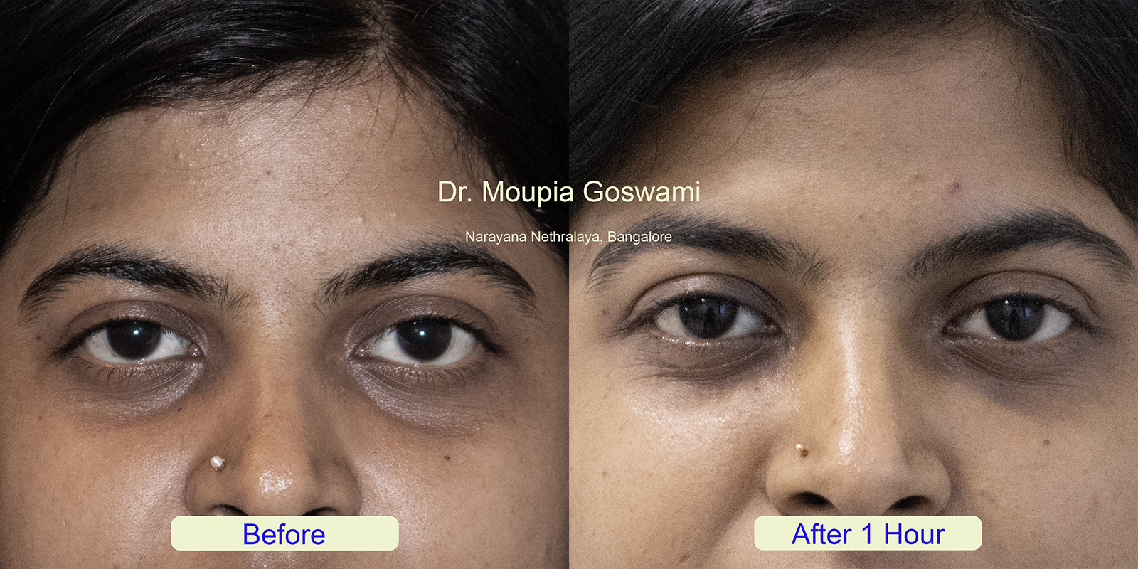 Dark circle treatment before after image 3