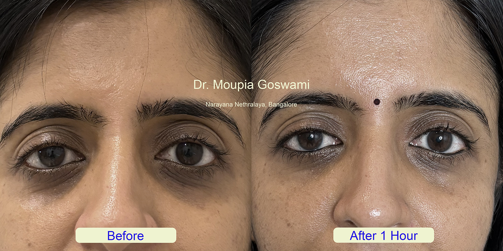 Dark circle treatment before after image 4