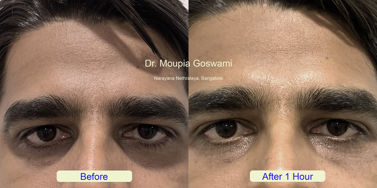 Dark circle treatment before after image 5