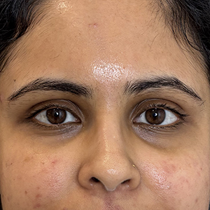 Moderate Dark Circles