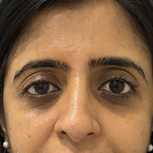 Moderate Dark Circles