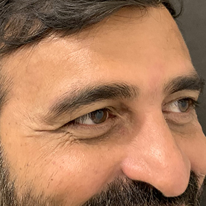 Fine Lines Around Eyes