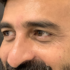 Moderate Eye Wrinkles