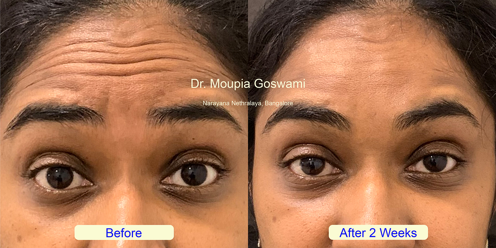 Forehead lines treatment photo 1