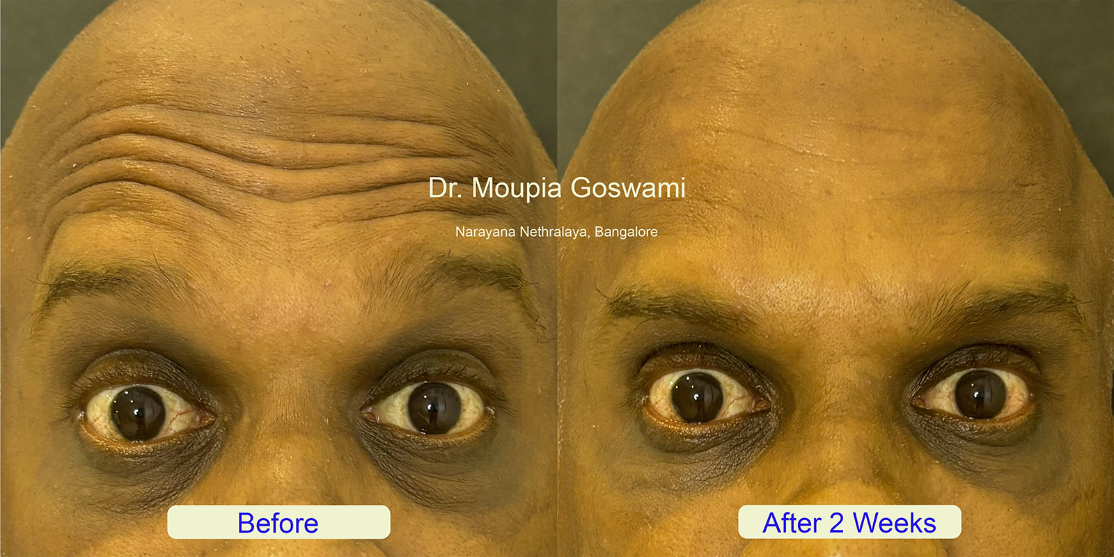 Forehead lines treatment photo 1