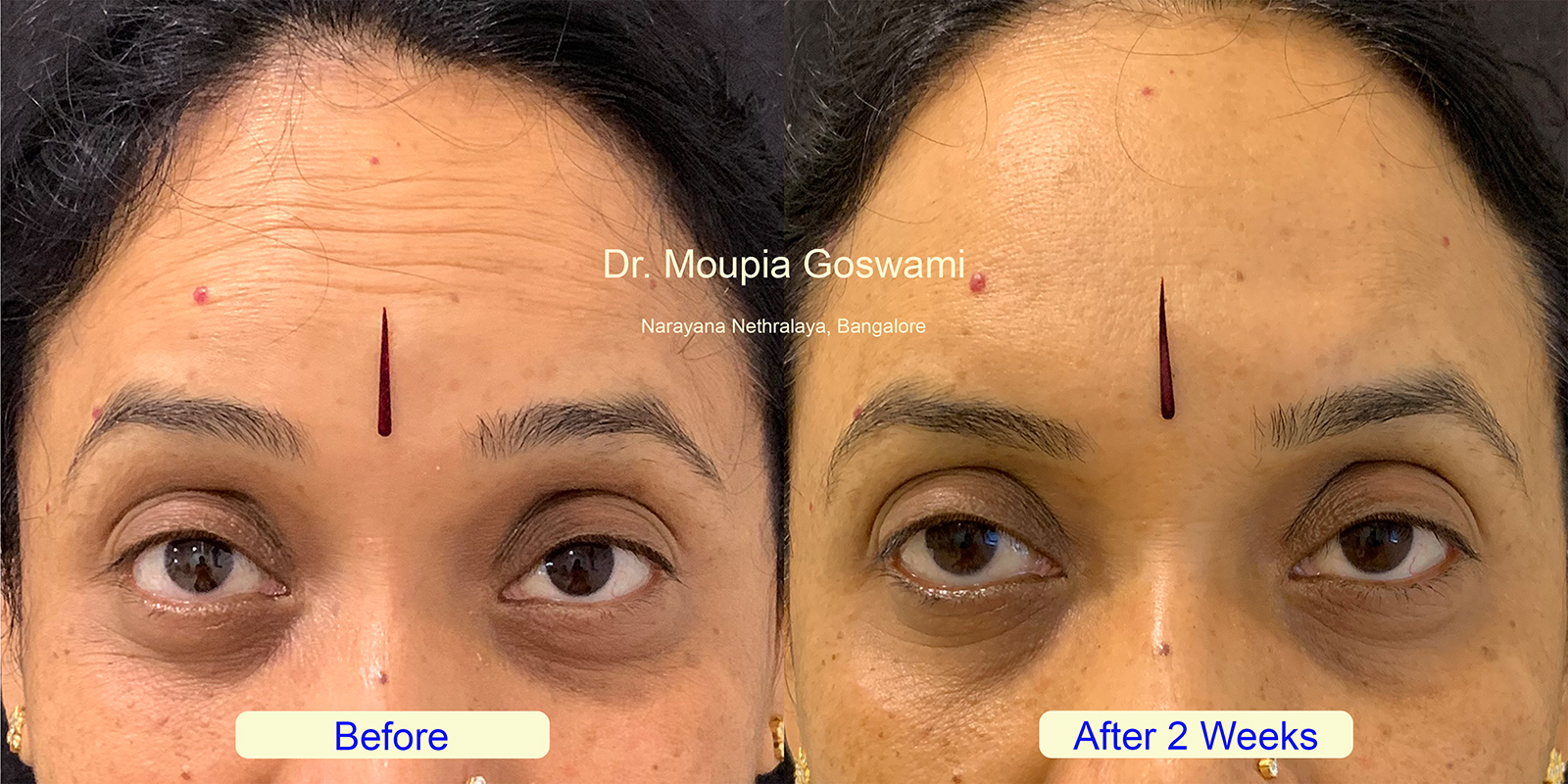 Forehead lines treatment photo 1