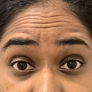 Forehead Lines photo 1