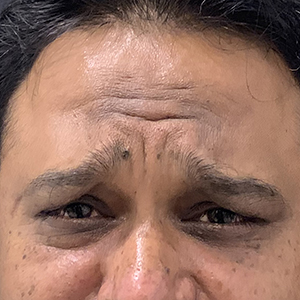 Forehead Lines photo 2