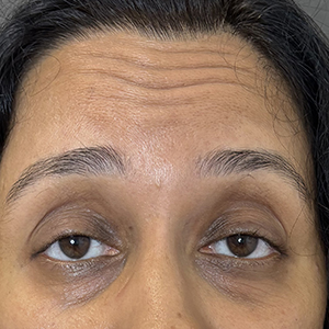 Forehead Lines photo 3