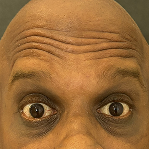 Forehead Lines photo 4