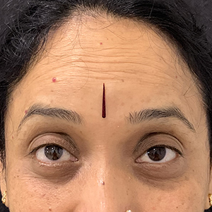 Forehead Lines photo 5