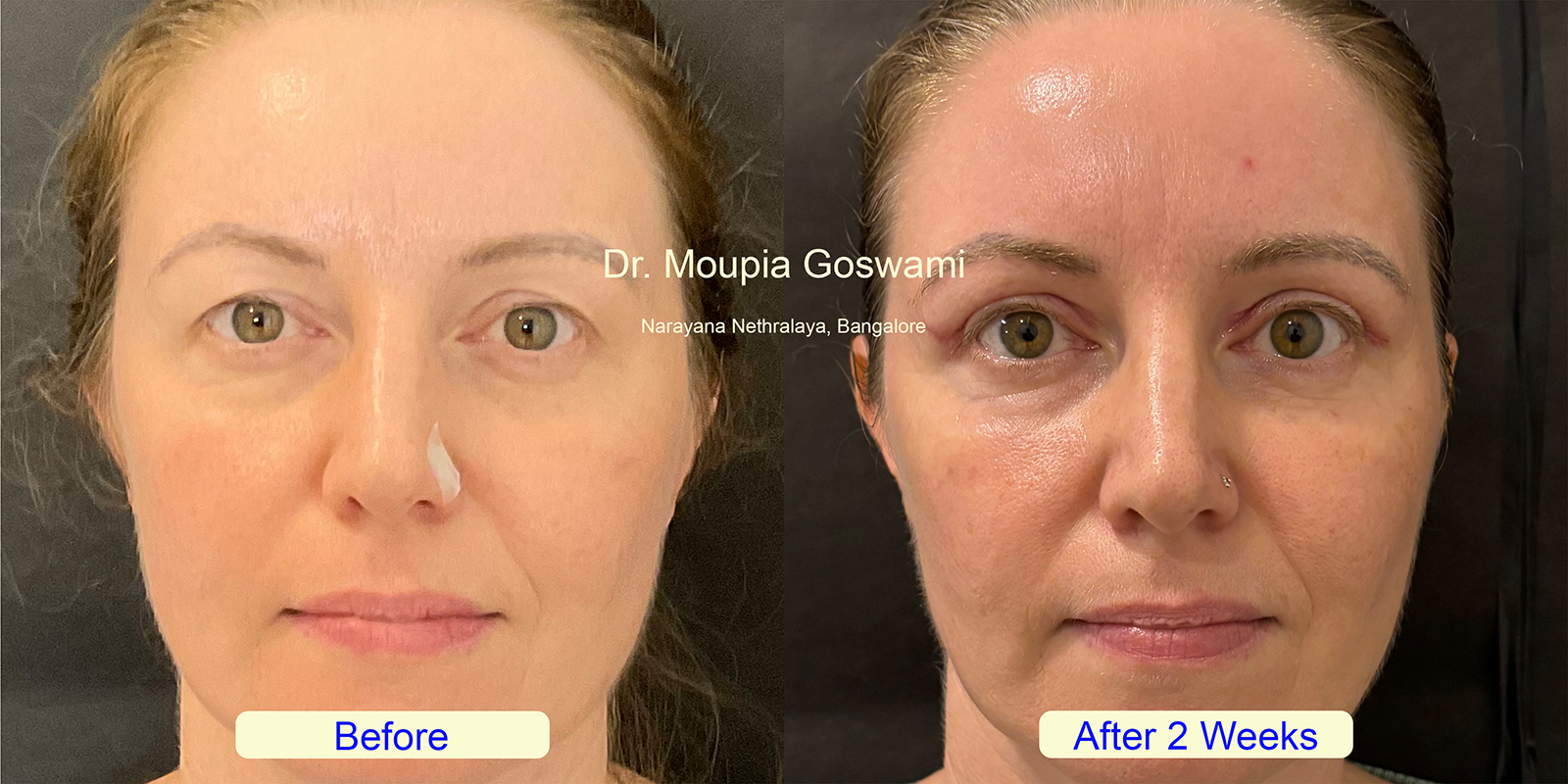 Before and After Hooded Eyes Treatment