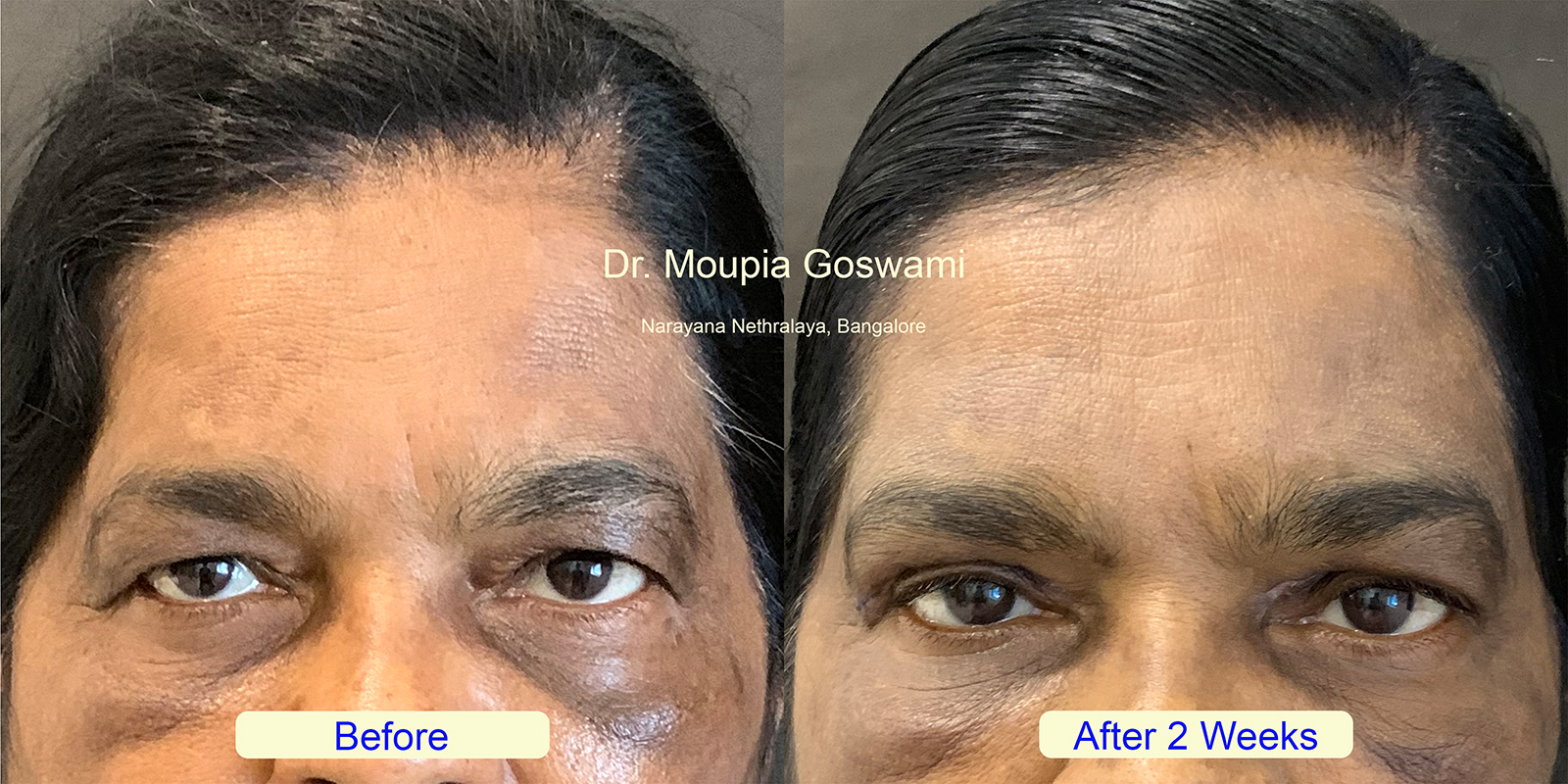 Hooded Eyes Treatment Results